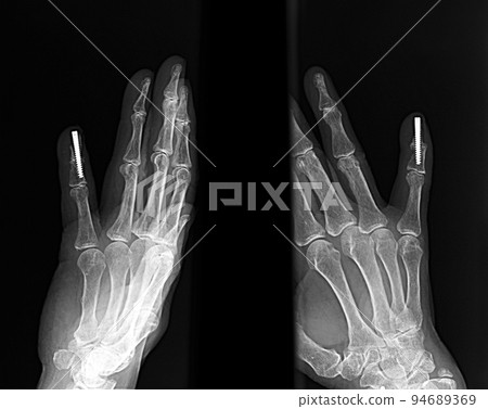 手部手指 X 線照片 Hebaden 結節治療 關節融合術 手部手指 X 線照片 Hebaden 結節治療 關節融合術 94689369