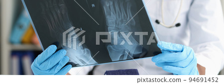 Doctor traumatologist examines x-ray of feet closeup 94691452