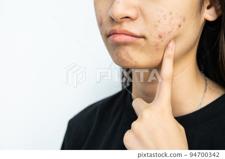 Cropped shot of woman pointing to an acne problem on her cheek. Inflamed acne consists of swelling, redness, and pores that are deeply clogged with bacteria, oil, and dead skin cells. Cropped shot of woman pointing to an acne problem on her cheek. Inflamed acne consists of swelling, redness, and pores that are deeply clogged with bacteria, oil, and dead skin cells. 94700342