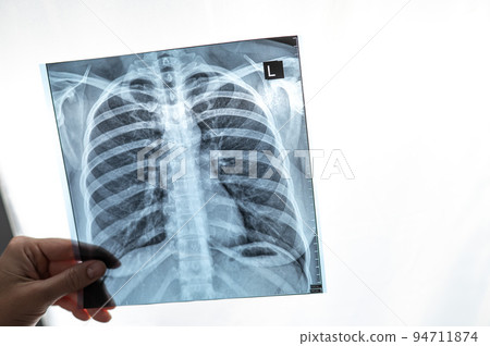 Doctor showing x-ray of patient's lungs.  94711874