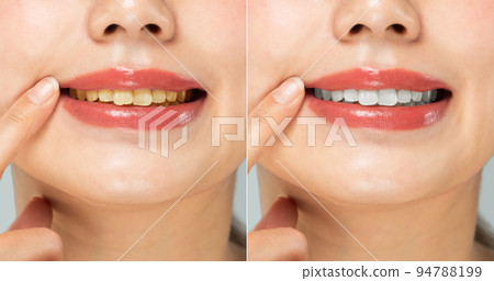 Whitening 94788199