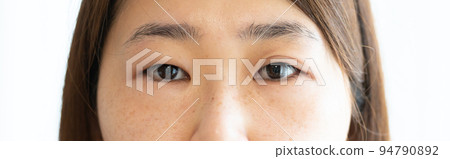 A woman with swollen eyes and a single eye A woman with swollen eyes and a single eye 94790892