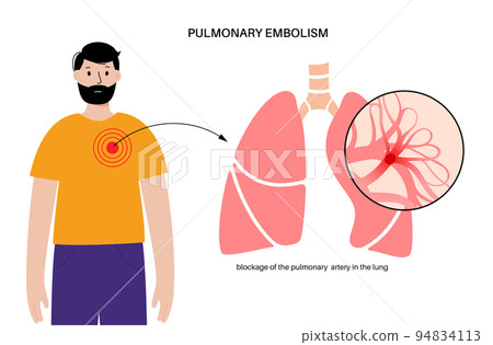 Pulmonary embolism disease Pulmonary embolism disease 94834113