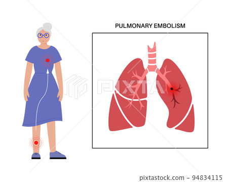 Pulmonary embolism disease 94834115