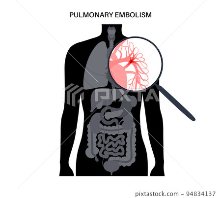 Pulmonary embolism disease Pulmonary embolism disease 94834137