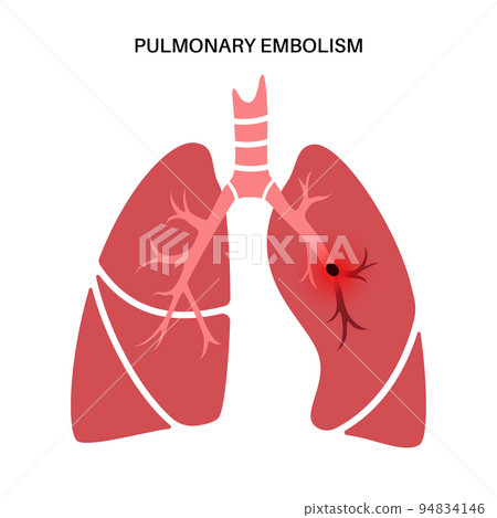Pulmonary embolism disease Pulmonary embolism disease 94834146