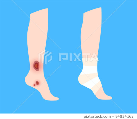 Human leg injury 94834162