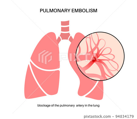 Pulmonary embolism disease 94834179