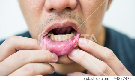 Painful aphtha ulcer man's mouth from accident or not enough sleep Painful aphtha ulcer man's mouth from accident or not enough sleep 94837475