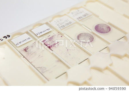 Traditional and liquid based cytology microscope slides for pap smear test. Cervical cancer concept. Medical concept. 94859390