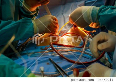 As part of the heart operations due to coronary heart disease that are being performed in the operating room of a hospital, coronary artery bypass grafts are being performed 94860915