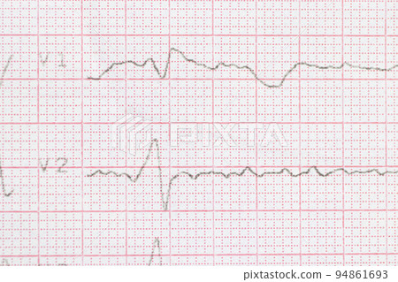 Macro or close-up ECG cardiogram of a patient with left bundle branch block. Diagnosis and treatment of heart disease 94861693