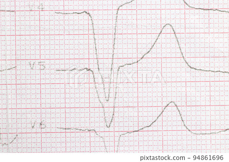 Macro photo of ECG cardiogram of a patient with a heart attack. Macro photo of ECG cardiogram of a patient with a heart attack. 94861696