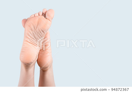 Dry skin on heel. Dry and cracked soles of feet on gray background, foot with dry heels, cracked skin heel of foot with bad skin is covered with cracks. Dry skin on heel. Dry and cracked soles of feet on gray background, foot with dry heels, cracked skin heel of foot with bad skin is covered with cracks. 94872367