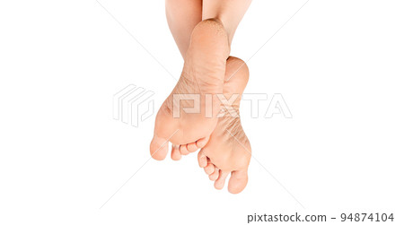 Dry and cracked soles of feet on white background. Dry Female heels. rough skin on female feet. Dry and cracked soles of feet, copy space Dry and cracked soles of feet on white background. Dry Female heels. rough skin on female feet. Dry and cracked soles of feet, copy space 94874104