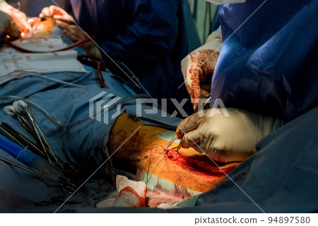 It is not uncommon for doctors in the operating room to sew up an injured leg 94897580