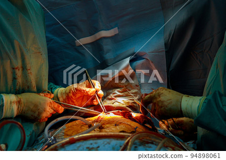 Coronary artery bypass graft CABG for heart operations due to disease coronary heart disease Coronary artery bypass graft CABG for heart operations due to disease coronary heart disease 94898061