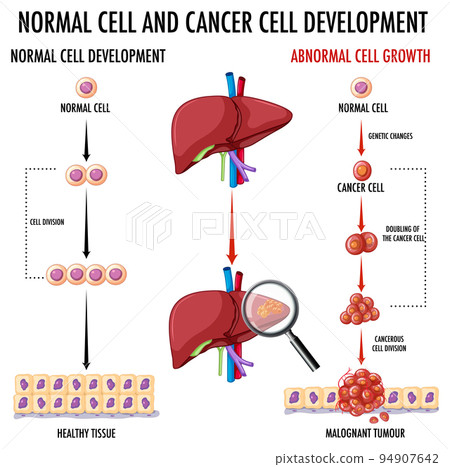 Diagram showing normal and cancer cell Diagram showing normal and cancer cell 94907642