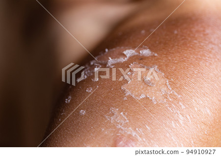 Peeling skin from a sunburn 94910927