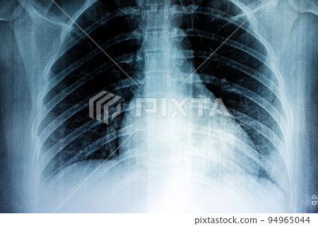 Film X-ray Film X-ray 94965044