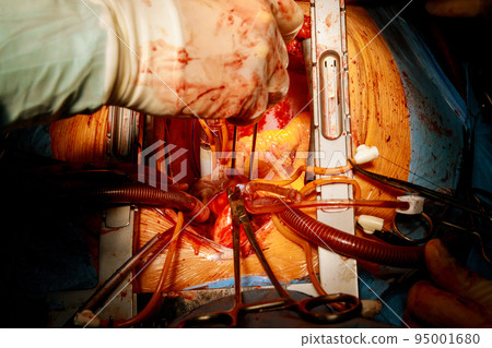 The process of coronary artery bypass graft CABG for heart operations due to coronary heart disease takes place in the operating room of a hospital 95001680