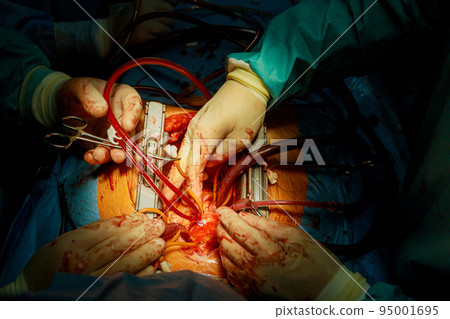 A heart valve replacement in the operation room is required when there is a malfunctioning heart valve that requires open heart surgery A heart valve replacement in the operation room is required when there is a malfunctioning heart valve that requires open heart surgery 95001695