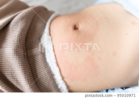 baby with hives 95010971