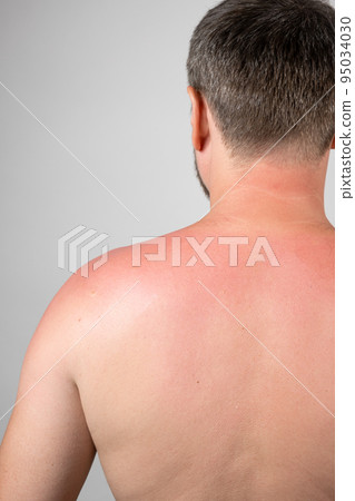 Back of a man with a sunburn, close-up. 95034030