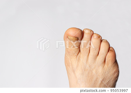 Fungus of nails on the big toe - dermatomycosis and onychomycosis, fungal infection macro photo. Dermatology, treatment of nail mycosis. 95053997