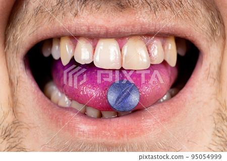 A person shows an indicator pill on his tongue to determine plaque. A person shows an indicator pill on his tongue to determine plaque. 95054999
