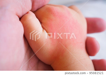 baby hand with skin rash and allergy with red spot cause by mosquito bite 95081521