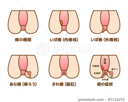 痔瘡症狀類型的插圖材料集 痔瘡症狀類型的插圖材料集 95119255