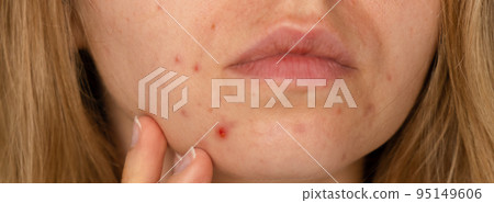 Unrecognizable woman showing her acne on face. Banner Close-up acne on woman's face with rash skin ,scar and spot that allergic to cosmetics. Problem skincare and health concept. Wrinkles, melasma 95149606