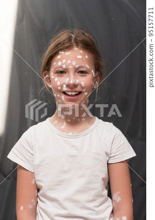 Portrait of a little school girl with chickenpox, antiseptic cream applied to face and body .Chalkboard background.  95157711