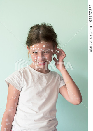 Portrait of a little school girl with chickenpox, antiseptic cream applied to face and body .Colorful background.  95157883