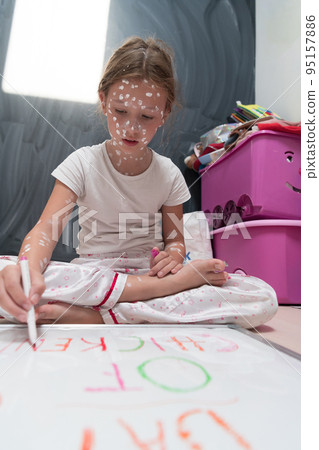 Little school girl with chickenpox drawing on white board in kids' room, antiseptic cream applied to face and body. Chalkboard and toys background.  95157886