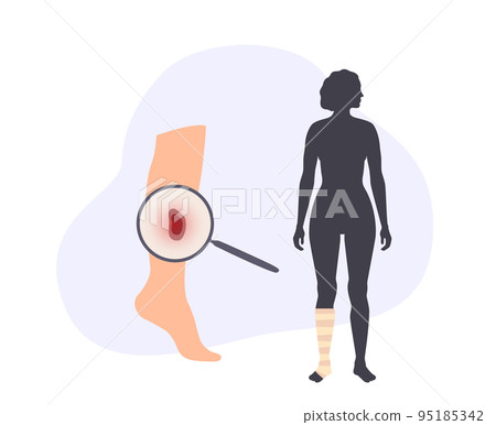 Human leg injury 95185342