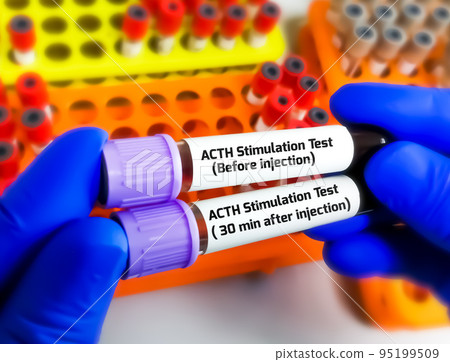 Scientist holding blood samples for ACTH Stimulation test. short Synacthen test. Before injection and after injection  95199509
