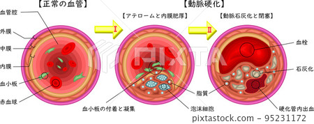 Arteriosclerosis Illustration Japanese 95231172
