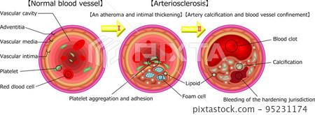 Arteriosclerosis Illustration English 95231174