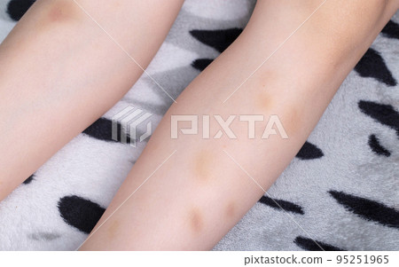 Spots, bruises on the legs of a child. The concept of injuries, lack of micro and macro elements, vitamins in the body. Spots, bruises on the legs of a child. The concept of injuries, lack of micro and macro elements, vitamins in the body. 95251965