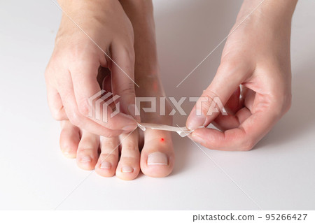 A woman glues a plaster for the treatment of calluses and calluses to her toe. Close-up 95266427