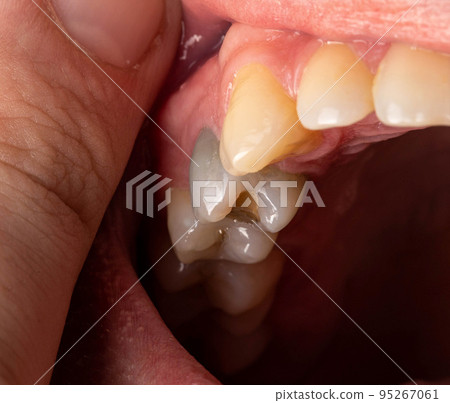 A black tooth in a man's mouth after removal of a nerve and filling of dental canals with low-quality materials. Tooth whitening, close-up 95267061