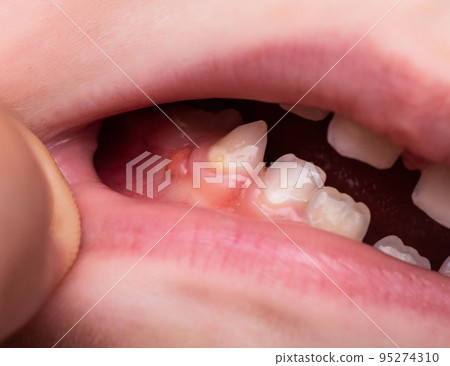 A bump is a tumor on the tooth gum in a child. Periodontitis in children due to a tooth with pulpitis. Close-up 95274310