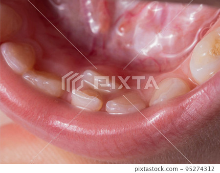 A permanent molar in a child grows second row. Incorrect growth of molars or polyodontia in dentistry, close-up 95274312