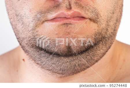 The face of an overweight man. Fat double chin. Aesthetic defect. double chin correction, close-up 95274448