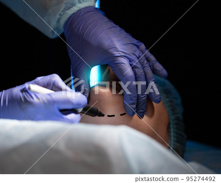 Plastic surgery to correct and remove a double chin in a female patient. Mentoplasty, close-up 95274492