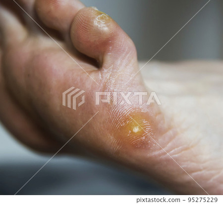 Plantar wart and callus on the patient's foot. Removal of warts and skin care on the soles of the feet, macro Plantar wart and callus on the patient's foot. Removal of warts and skin care on the soles of the feet, macro 95275229
