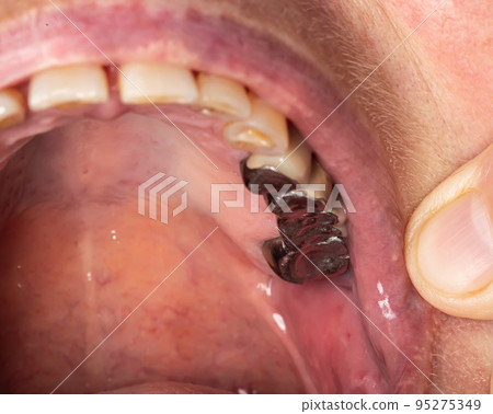 Old metal crowns in the patient's mouth on the chewing teeth. Dental prosthetics, macro Old metal crowns in the patient's mouth on the chewing teeth. Dental prosthetics, macro 95275349