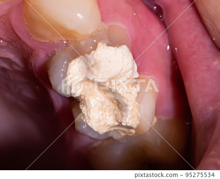 Tooth with temporary filling for nerve destruction and pulpitis treatment, macro. Dentistry 95275534